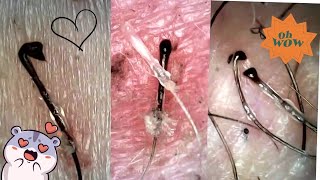 Hair Follicle Plucks Under the Microscope Big Roots  Super Satisfying [upl. by Massab]