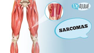 SARCOMA O QUE É DIANÓSTICO TIPOS TRATAMENTO E FATORES DE RISCO [upl. by Scharaga725]