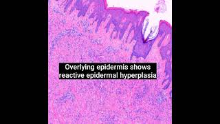 Histopathology of Cellular Dermatofibroma dermpath dermatopathology shorts [upl. by Arua282]