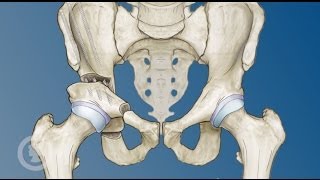 Hip Preservation Options for Young Adults [upl. by Agbogla]