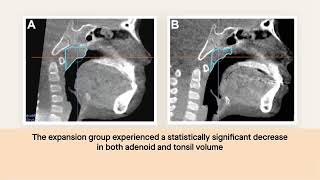 Palate widening with orthodontics reduces the size of adenoids and tonsils in children [upl. by Atirahc126]