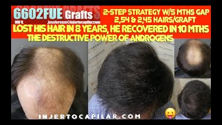 6602Grafts NWV Lost his hair in 8yrs recovered in 10mths 2step strategy w5 mths gap 28892023 [upl. by Allyson195]