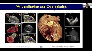 221120 Papillary Muscle VT ABL 박희남 교수 Hui Nam Pak [upl. by Pam]