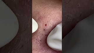 Big Cystic Acne Blackheads Extraction Blackheads amp Milia Whiteheads Removal Pimple Popping shorts [upl. by Aihtyc512]