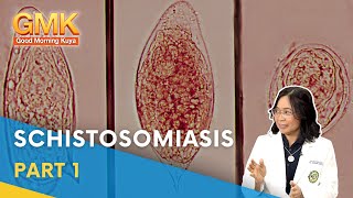 Schistosomiasis Causes Symptoms and Treatment Part 13  Usapang Pangkalusugan [upl. by Adnalahs]