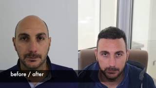 Hair transplant before after FUE Hair transplant [upl. by Ahsit]