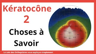 Comment soigner un kératocône  Comment savoir si on a un kératocône [upl. by Valente282]