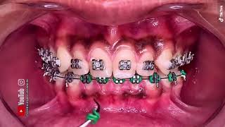 ¡🔥Tienes la encía pigmentada  ¿cómo se llama esta situación R\\MELANOSIS GINGIVAL🔥 [upl. by Ruder]