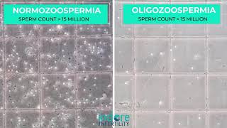 Oligozoospermia  Low Sperm Count Comparison of Normal Semen Sample with sample with Low Count [upl. by Muns233]