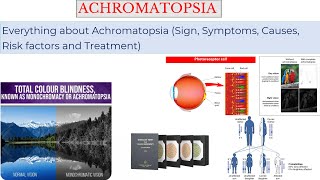 Achromatopsia Causes Risk factors Etiology Sign Symptoms and treatment of color blindness [upl. by Alicec214]