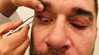 Meibomian gland dysfunction PART 2 youtubeshorts youtubevideos youtube dryeye [upl. by Gemmell414]