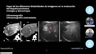 Cirrosis Imágenes en lesiones benignas y malignas [upl. by Eninaj]