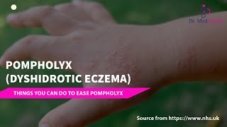 Pompholyx  Dyshidrotic eczema  dyshidrotic eczema treatment [upl. by Malinde691]