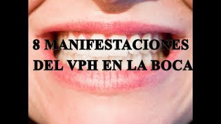 8 manifestaciones de VPH en la boca [upl. by Okime344]