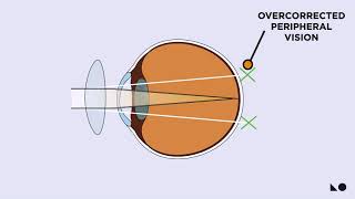 How OrthoK Works amp How It Slows Myopia [upl. by Anyad]