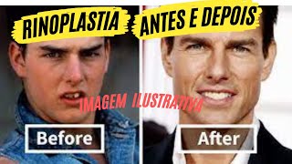 Nariz dos sonhos sem cirurgia Antes e Depois Fiz Rinomodelação estruturada resultado definitivo [upl. by Licht476]