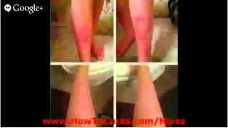 How To Get Rid Of Hives  Cures For Soothing Solar Urticaria  How To Get Rid Of Hives [upl. by Naitsihc]