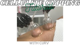 Cupping For Cellulite  Cupping Therapy on Legs [upl. by Roos]