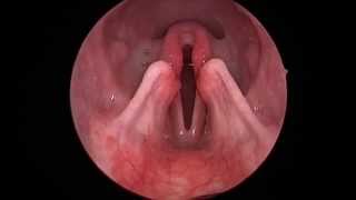 Dog Lar Par Laryngeal paralysis observed in sedated canine oral exam [upl. by Hintze948]