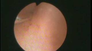 Hysteroscopic tubal cannulation Flexible hysteroscopy [upl. by Notrom]