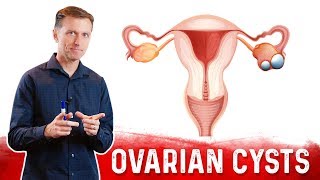 Ovarian Cysts Causes Symptoms amp Natural Treatment – DrBerg [upl. by Akeemahs]