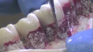 Popular Scaling Tips for Dental Hygienists and Dentists P2L P2R [upl. by Solitta]