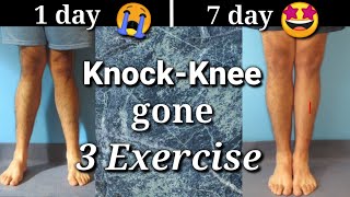 Knock knee problem solution with EXERCISES in 7 days [upl. by Eesdnil]