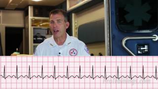 Supraventricular Tachycardia ECG Rhythm Interpretation [upl. by Niwhsa]