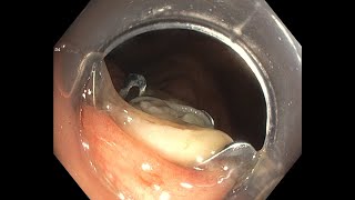 Full Thickness Resection of Appendiceal Orifice using Ovesco FTRD [upl. by Resiak607]