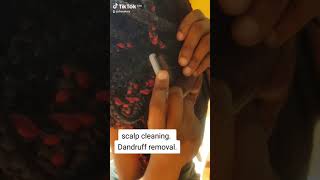 Check out my dandruff scratching video I did my own dandruff removal Tell me if you want more [upl. by Corilla961]