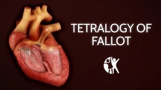 Tetralogy of Fallot  Cincinnati Childrens [upl. by Ihcego]