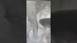 Varicocele Embolization  Varicocele treatment without surgery  Varicocele varicoceletreatment [upl. by Zetnom285]