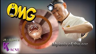 Omg Worms In The Ears  Myiasis Of The Ears [upl. by Hollingsworth]