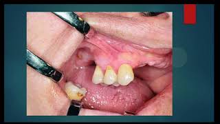 Oral Surgery L1 Preprosthetic Surgery [upl. by Nnayllas]