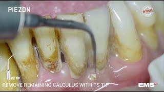 Guided Biofilm Therapy Step 06 Calculus removal with PIEZON® and the PS instrument [upl. by Ilatan]