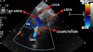 Aortic Coarctation Echocardiography Findings [upl. by Noswad913]