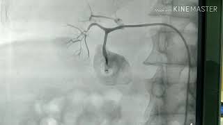 Renal artery coilingembolization [upl. by Wiencke]