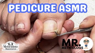 👣ASMR Pedicure Cleaning💆‍♀️ Epic Impacted Toenail Debris Removal on Mr Meticulous👣 [upl. by Jarv]