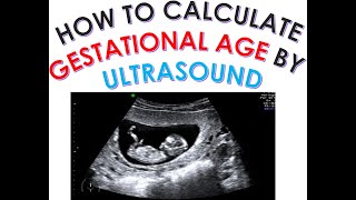 HOW TO CALCULATE GESTATIONAL AGE AND EDD DUE DATE BY ULTRASOUND DATING SCAN SECOND TRIMESTER SCAN [upl. by Maidel]