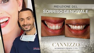 Come Ridurre il Sorriso Gengivale  Studio Cannizzo [upl. by Aihseym]