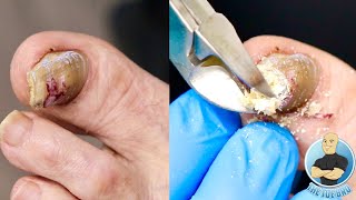 SUPER THICK TOENAIL TRIMMING AND FILING [upl. by Iteerp]