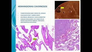 NÓDULOS Y TUMORES HEPÁTICOS [upl. by Natehc457]
