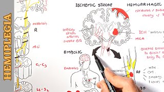 Hemiplegia part 1  causes pathophysiology stages and manifestations [upl. by Arakahs542]