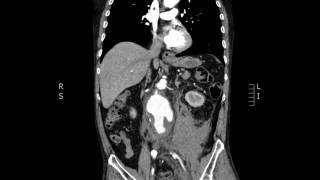 Ruptured AAA Coronal CT JETem 2017 [upl. by Twila929]