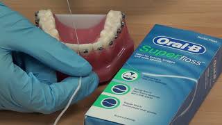 How to use the superfloss between dental bridge [upl. by Gower]