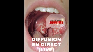 ANGINE QUESTIONS ET REPONSES Diffusion en direct  Dr Toure [upl. by Srednas]