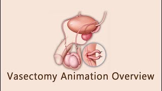 Vasectomy Animation Overview [upl. by Ajnek]