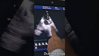 CortriatriatumLarge VSD amp PS 🤔😱 echocardiogram echocardiography heart cardiology heartdisease [upl. by Ailuy]