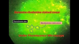 Auramine phenol stain Mycobacterium positveFluorescence microscope [upl. by Atteynod]