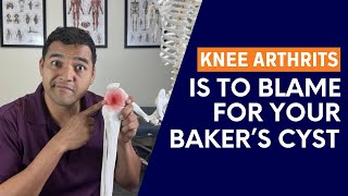 The Hidden Link Between Knee Arthritis and Bakers Cyst [upl. by Amuwkuhc]